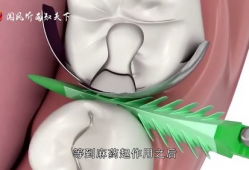 拔牙视频全过程,拔牙手术的惊心动魄瞬间